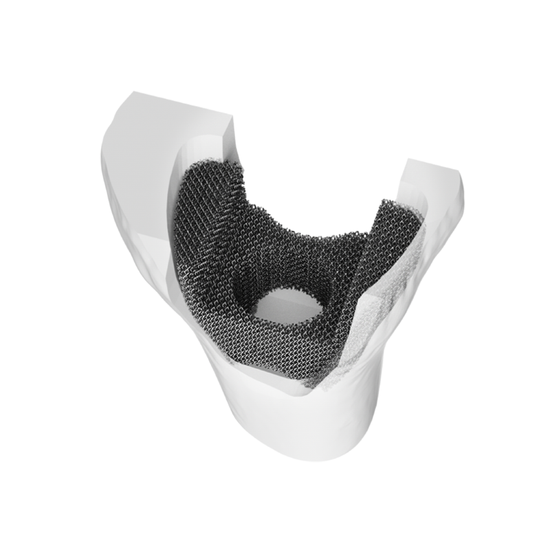 Tantalum Metal Trabecular Tibial Augment Type I