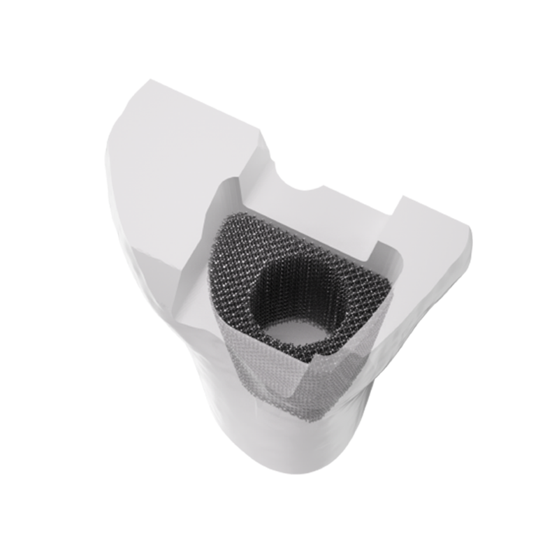 Tantalum Metal Trabecular Tibial Augment Type II