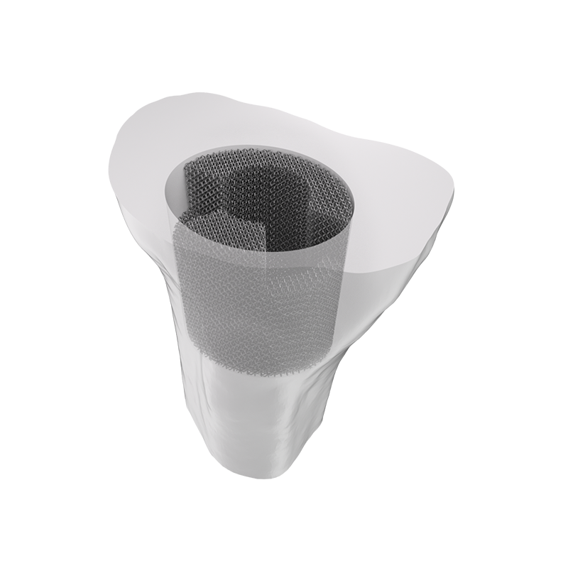Tantalum Metal Trabecular Tibial Augment Type IV