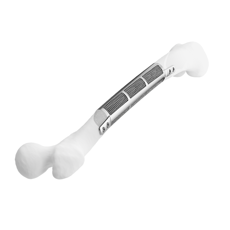 Large Segmental Bone Defect Reconstruction