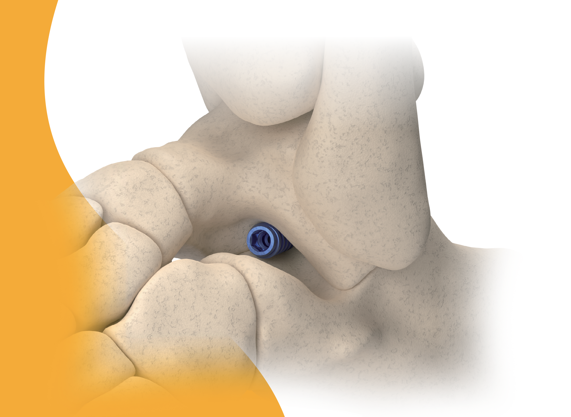 TalarLock™ Subtalar Arthroereisis System view 2