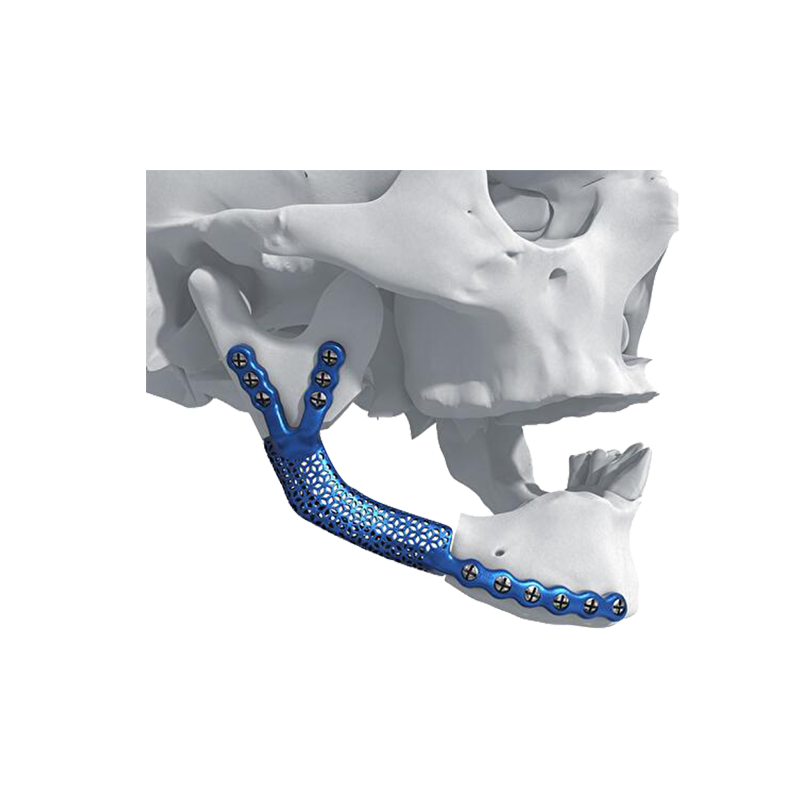 3D printed maxillofacial bone defect reconstruction implant