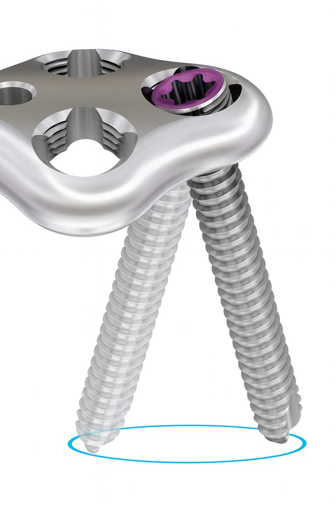 Variable angle foot and ankle plate and screw fixation system