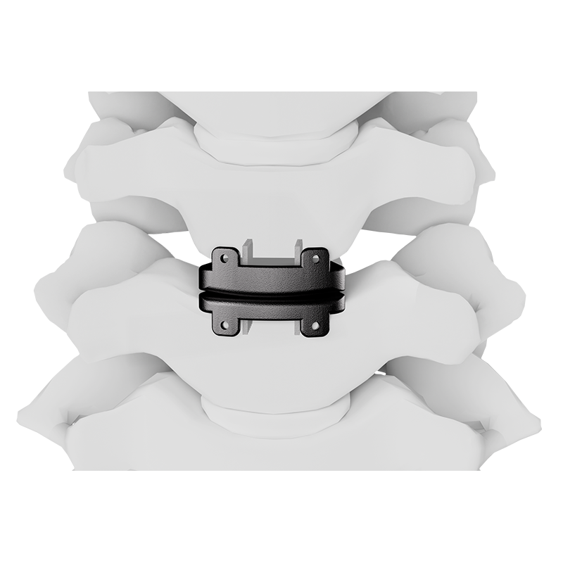 3D Printed Intervertebral Disc