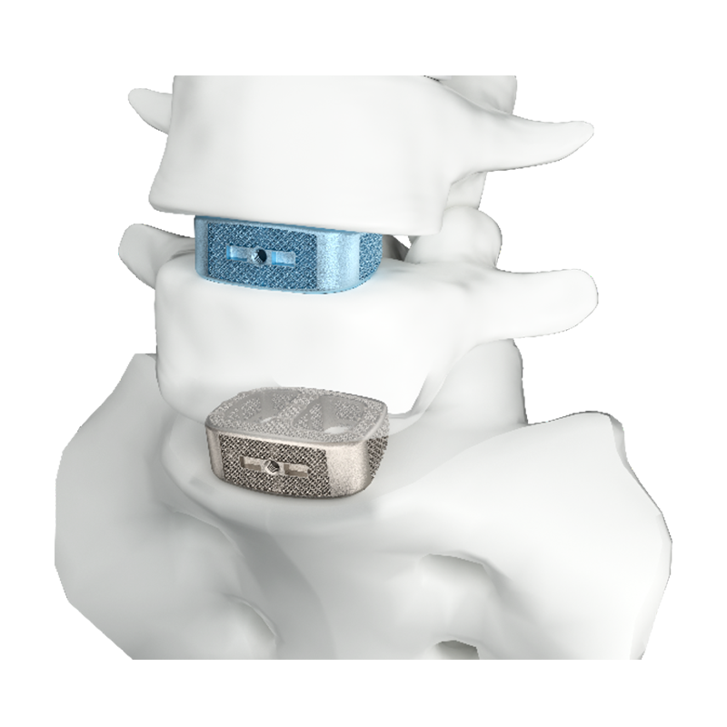 3D Printed Lumbar Anterior Interbody Fusion Cage