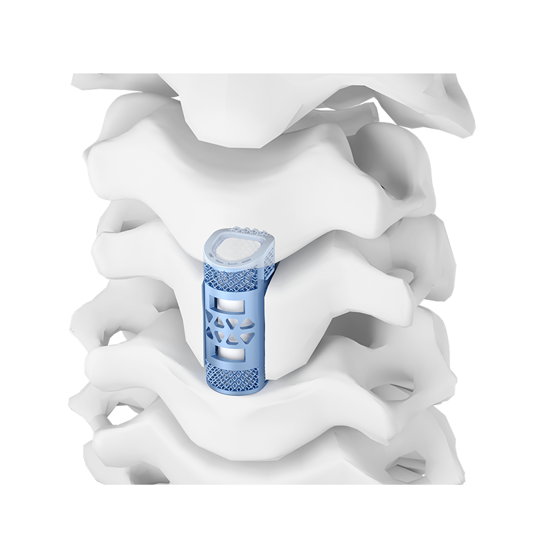 3D Printed Porous Cervical Artificial Vertebral Body Type I