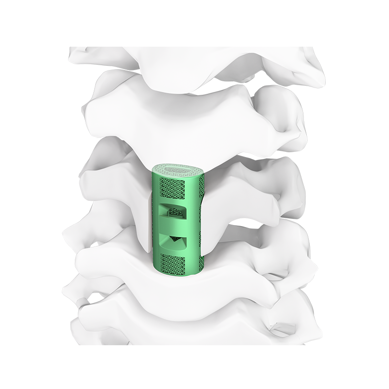 3D Printed Porous Cervical Artificial Vertebral Body Type III