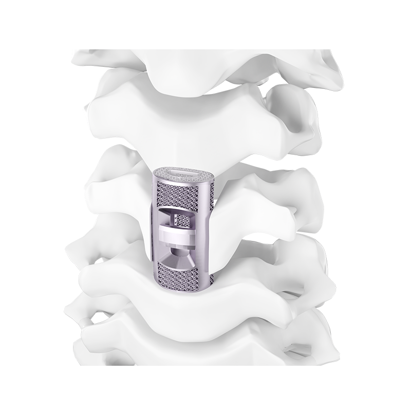 3D Printed Porous Cervical Artificial Vertebral Body Type IV