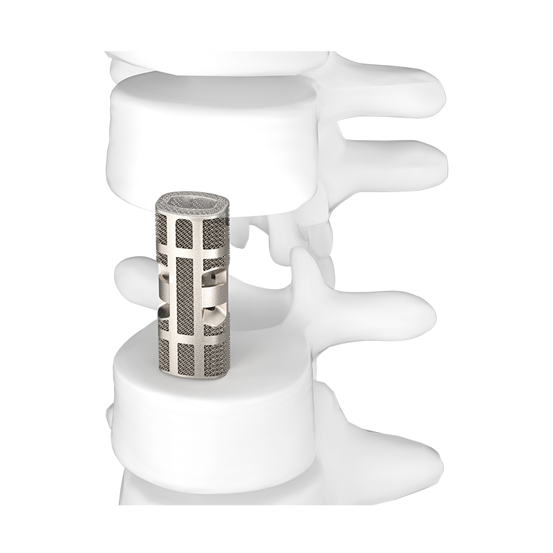 3D Printed Porous Thoracolumbar Artificial Vertebral Body Type I