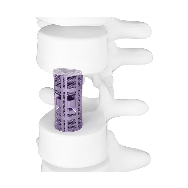 3D Printed Porous Thoracolumbar Artificial Vertebral Body Type III