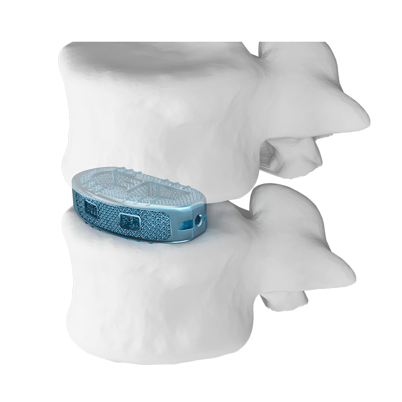 3D Printing Lumbar Lateral Interbody Fusion Cage