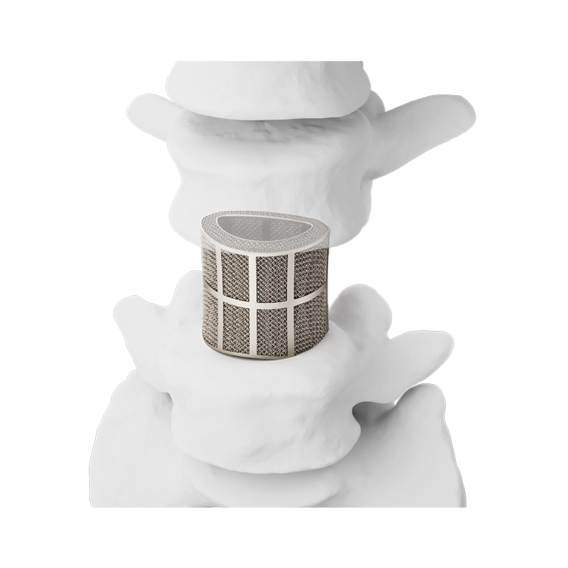 Metal 3D Printed Spinal Fusion Cage
