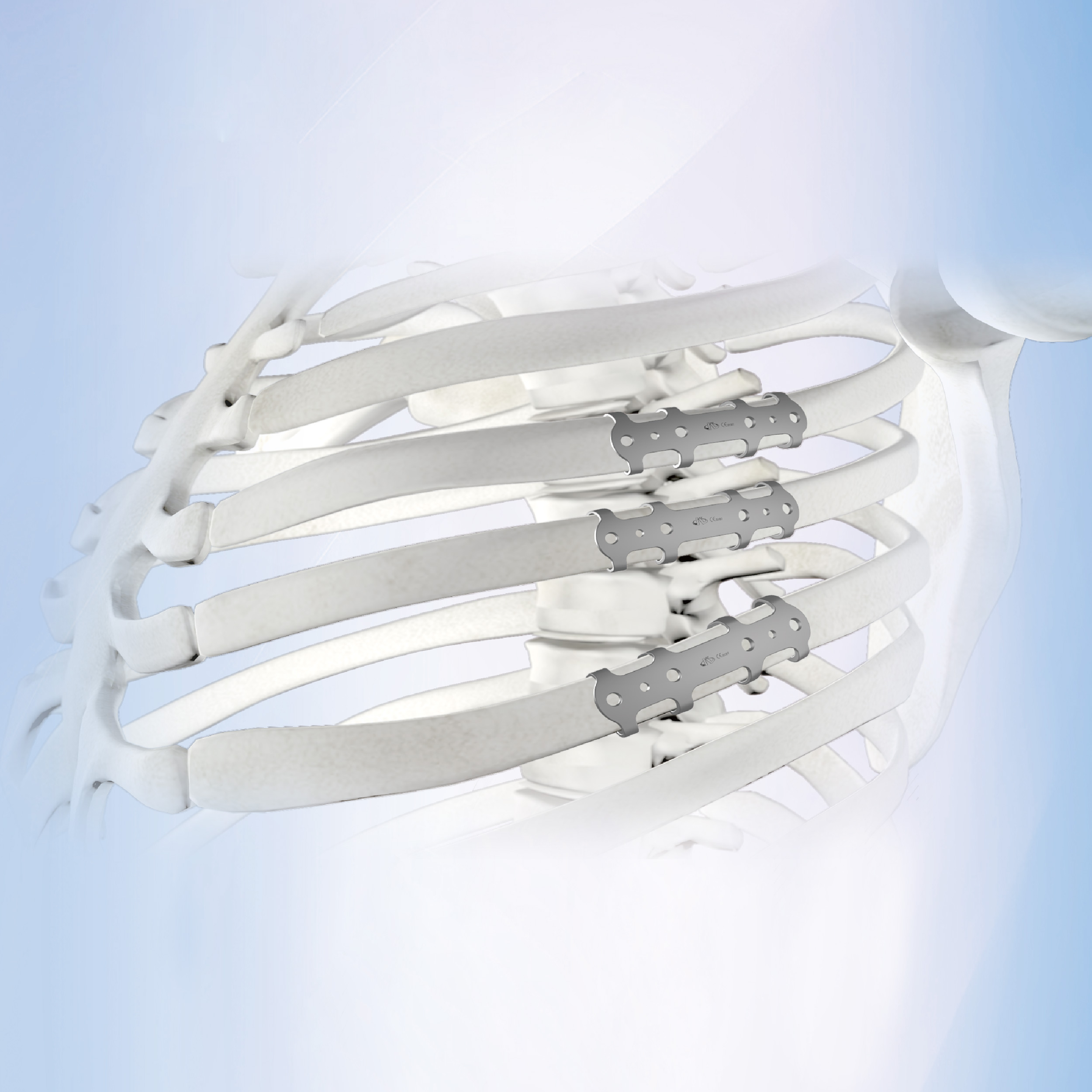 Pure Titanium Rib Plate System